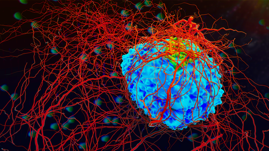 Cancer and Evolution: tumor with blood vessels which it evolved to grow.